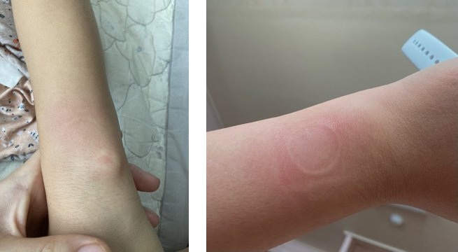 user hand with red skin from apple watch se overheating